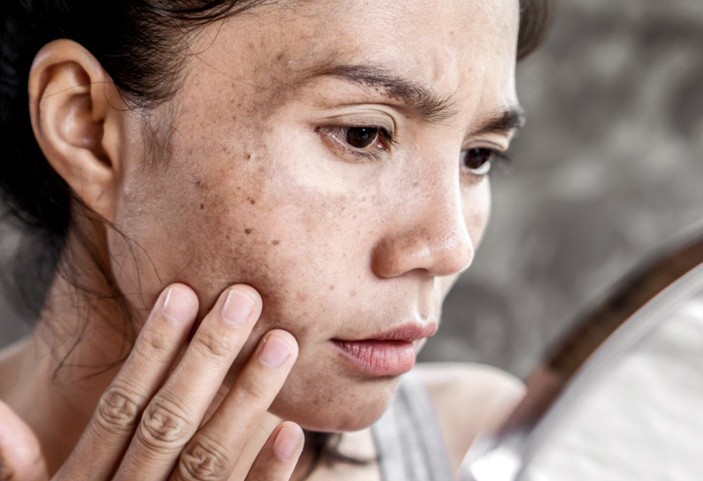 Spotlight on Hyperpigmentation: How to Treat Sun Damage Post-Summer